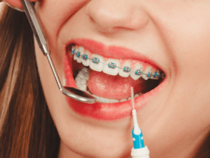 Braces-Friendly Foods Braces