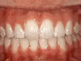 crowding of the teeth after