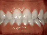 crowding of the teeth after