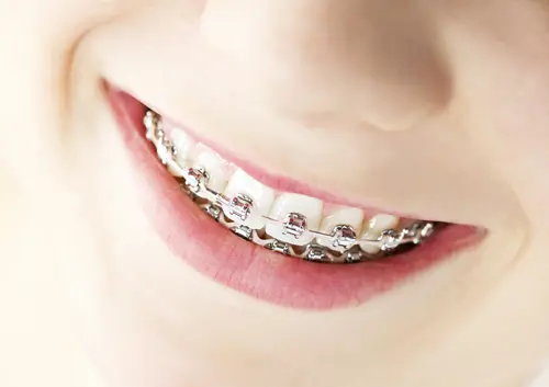 Invisalign Near Me