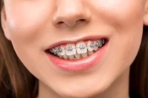 braces-in-tacoma