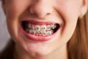 Braces near me