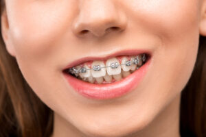 Cost Of Braces Tacoma Wa