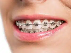 Yellow Teeth After Braces