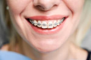 Braces-Friendly Foods Braces