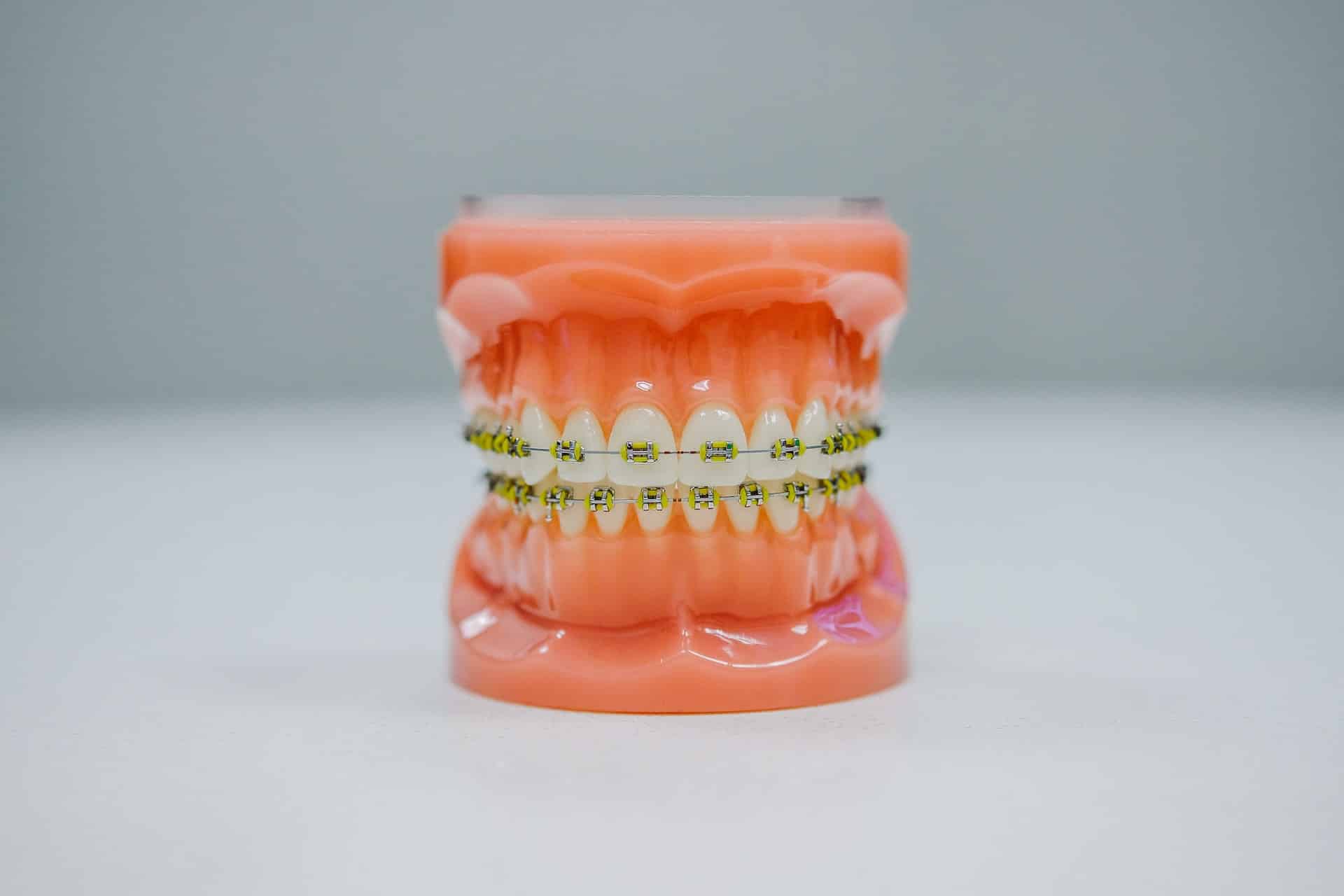 cost of braces Tacoma WA