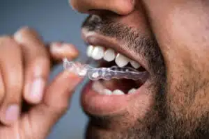 Can Invisalign Fix Crowding