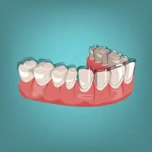 Can Invisalign Fix Crowding