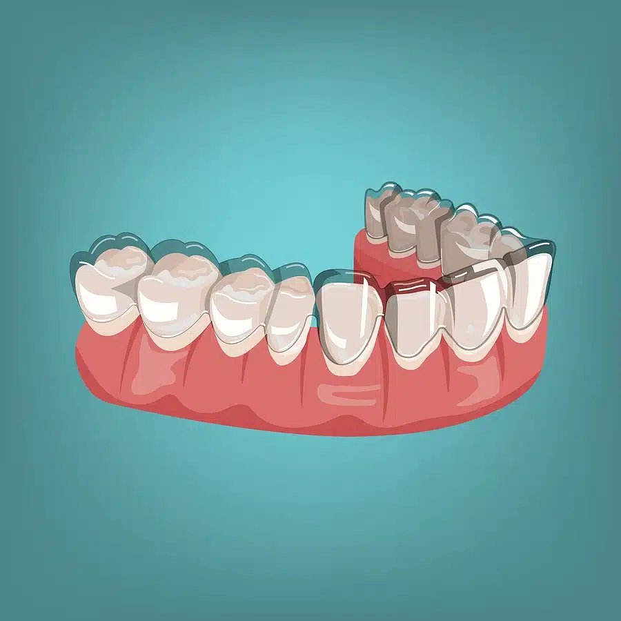 Invisalign Clear Braces Treatment for Crowded Teeth - Define