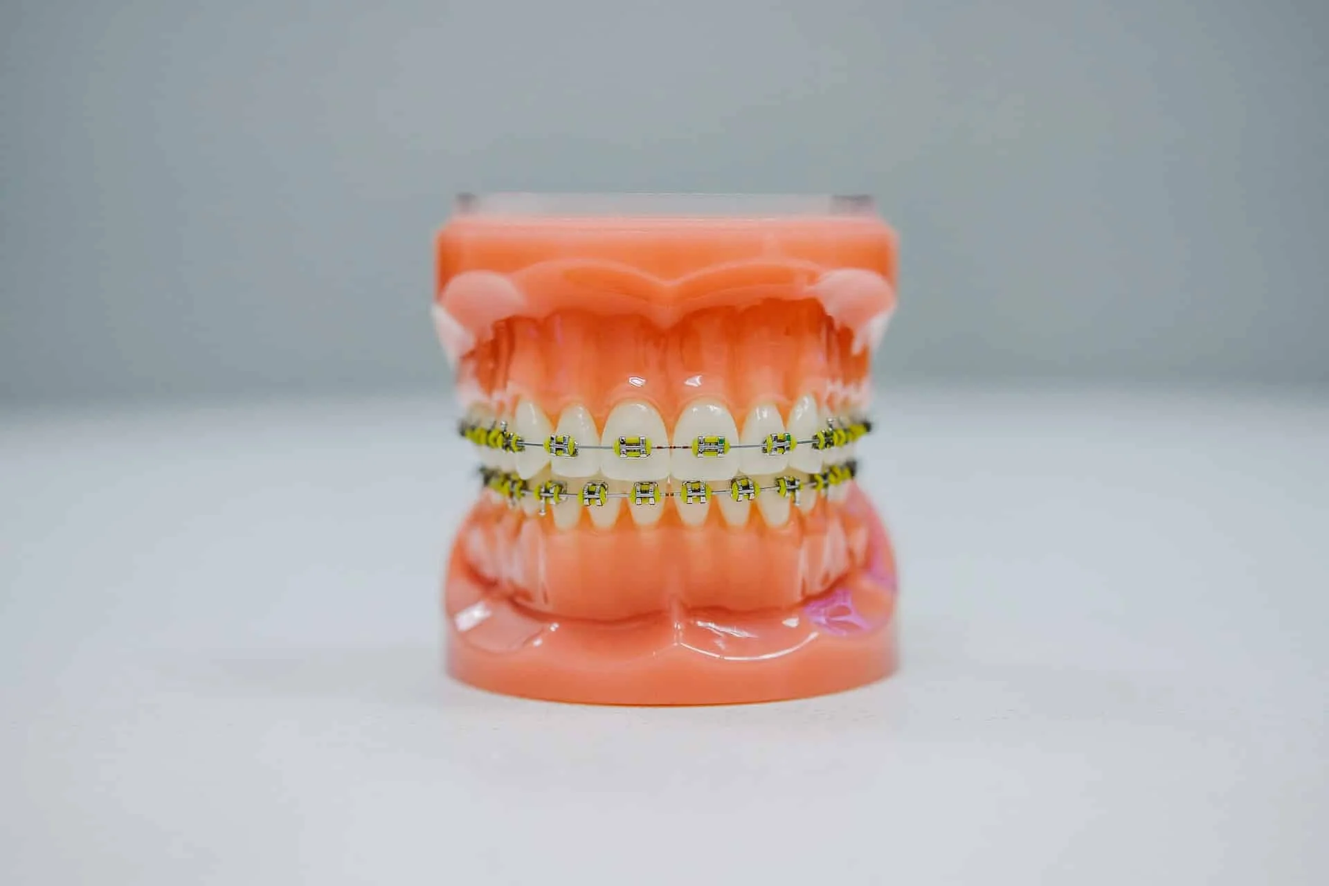 cost of braces Tacoma WA