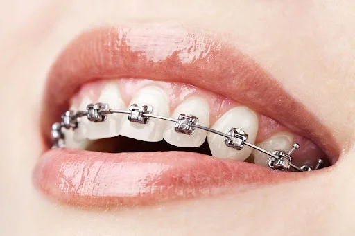 How Do Braces Work