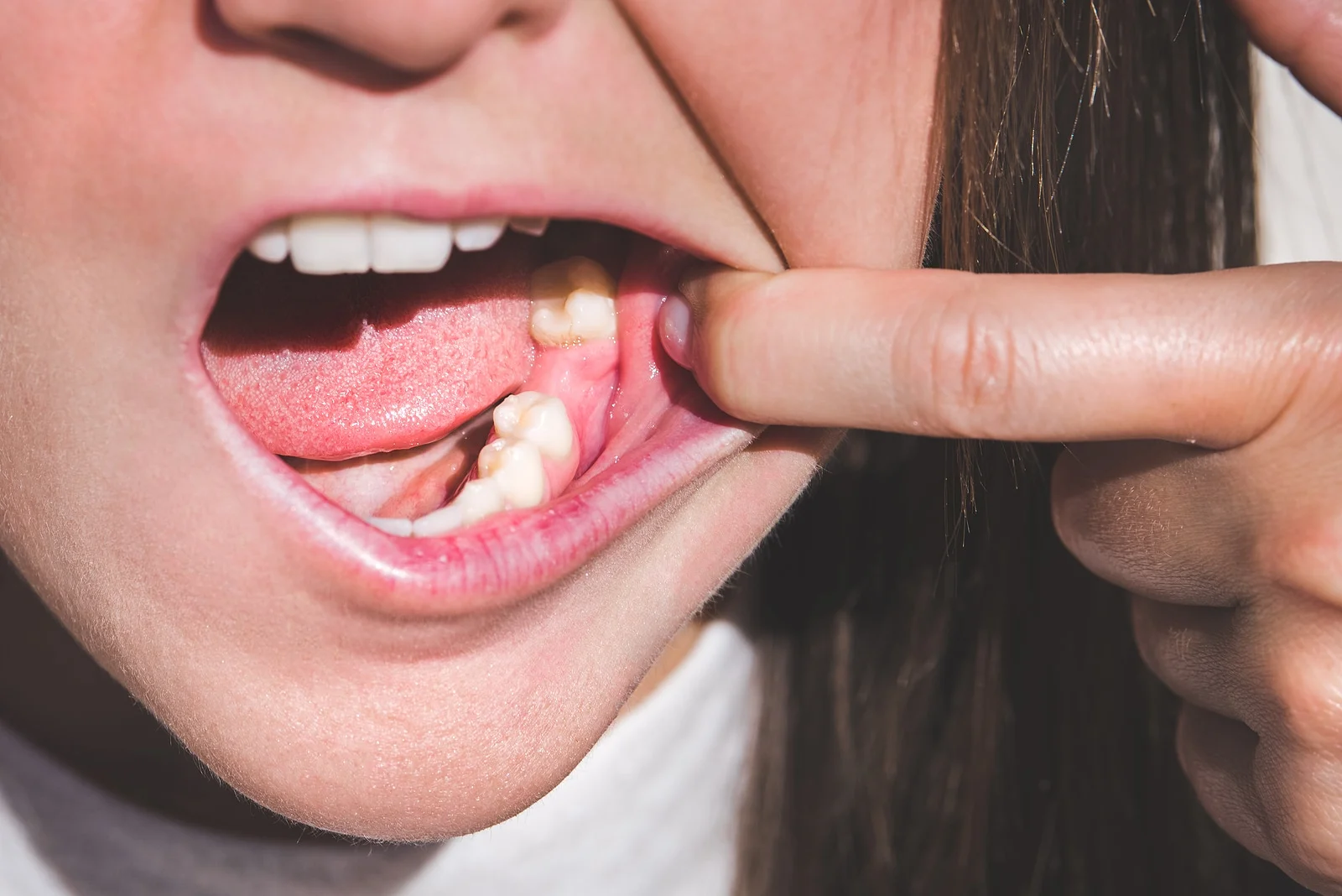 Woman showing a missing lower tooth before implant treatment
